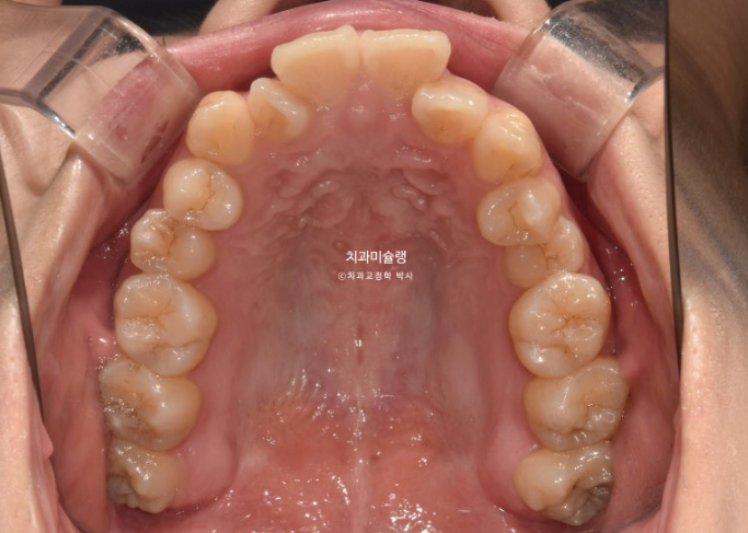 30대 인비절라인 덧니 발치교정 개방교합 치료 관련 이미지 5