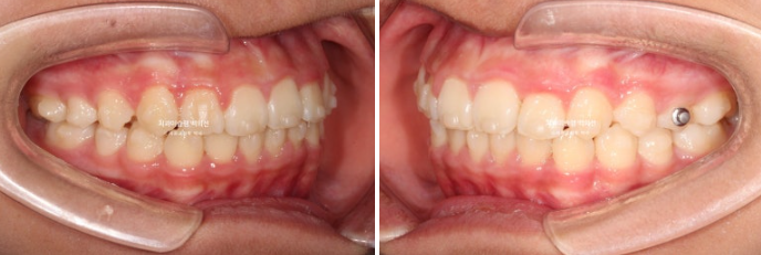 덧니 반대교합 과개교합 인비절라인 퍼스트 악궁확장 어린이 교정 관련 이미지 10