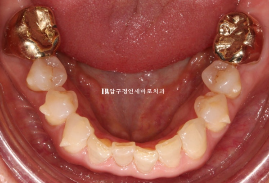 50대 치아교정 후기 | 앞니 부분교정과 무삭제 라미네이트로 자연스러운 안티에이징 관련 이미지 8
