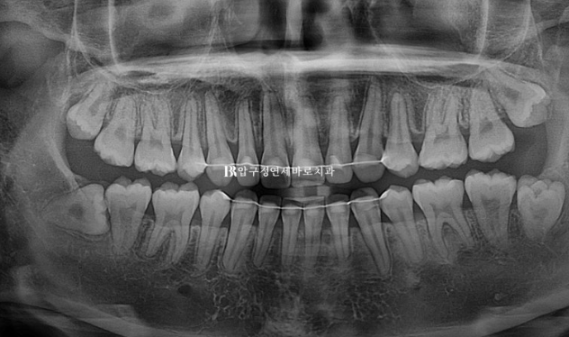 How Do the Buccal Corridors and Smile Line Change After Extraction Treatment for Protruding Teeth?|An Orthodontic Case That Also Improved Lip Incompetence image 18