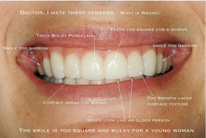 No-Prep Veneers Are Not the Right Treatment for Everyone image 2