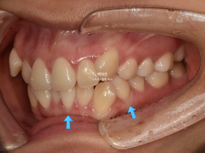 덧니 발치교정 클리피씨 입매 부작용 인중 입술 잇몸 퇴축 관련 이미지 3