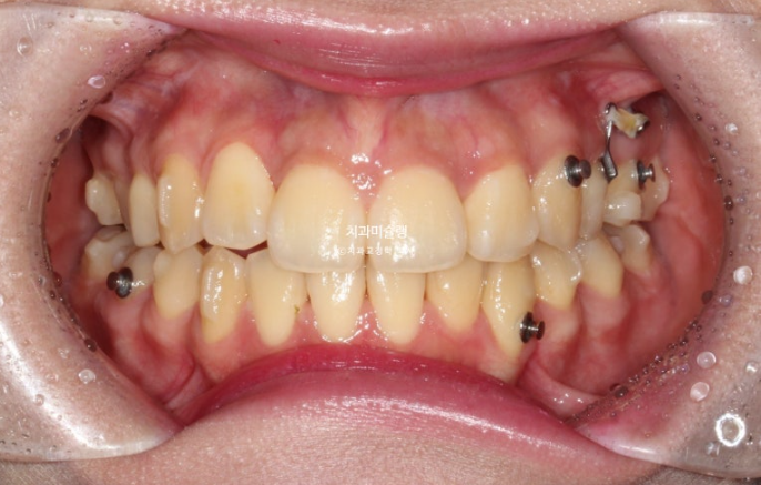 30대 인비절라인 덧니 발치교정 개방교합 치료 관련 이미지 9