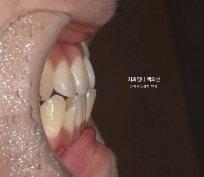 비발치 교정 덧니 인비절라인 교정 절단교합 반대교합 치료기간 1년 6개월 관련 이미지 7
