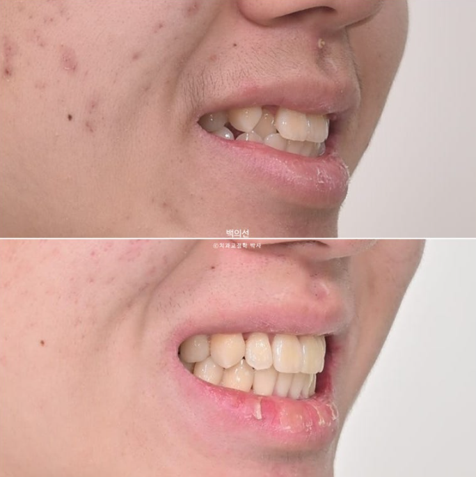 유학생 교정 덧니 반대교합 인비절라인 라이트 치료기간 관련 이미지 18