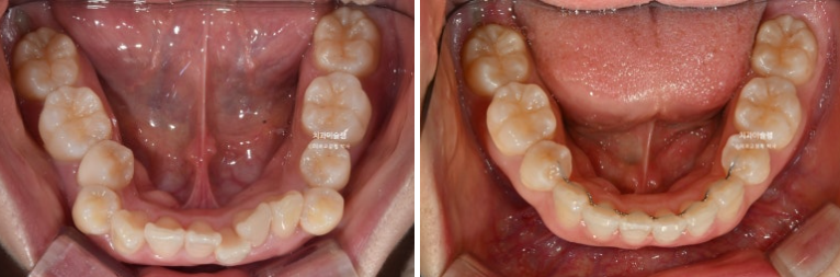 돌출입 덧니 발치 교정 인비절라인 교정 후기 관련 이미지 23
