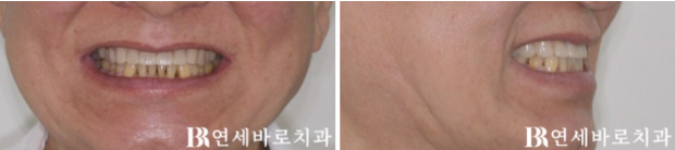 60대 무삭제 라미네이트 앞니 부분교정 치료 관련 이미지 7