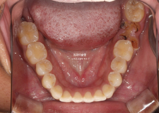 Extraction & re-orthodontics with Clippy-C, intrusion for dental implant. 관련 이미지 4