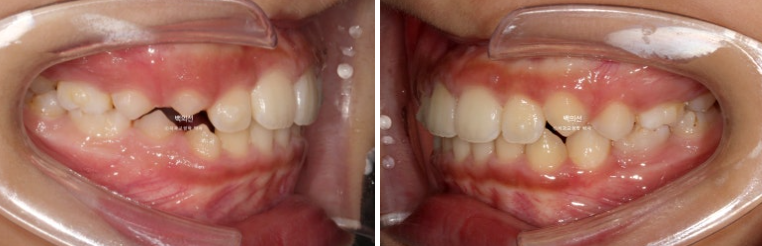 인비절라인퍼스트 어린이 투명교정 과개교합 덧니 악궁확장 돌출 관련 이미지 12