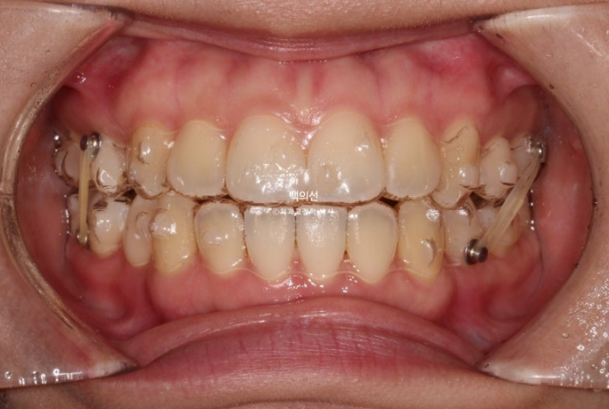 돌출입 교정 인비절라인 발치 교정 개방교합 치료 후기 관련 이미지 8