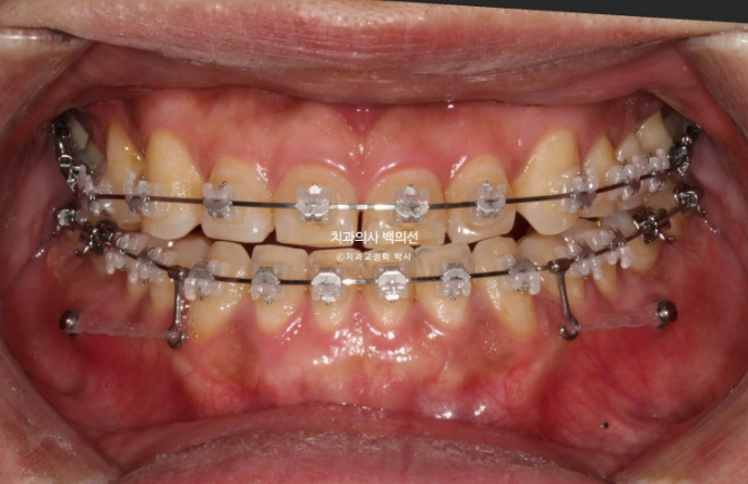 30대 주걱턱 비수술 비발치 교정 후기 관련 이미지 6