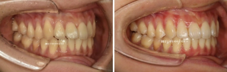 인비절라인 익스프레스 토끼이빨 앞니교정 ? 관련 이미지 11