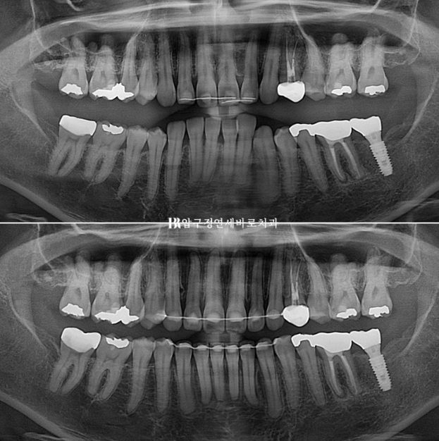 인비절라인 캔팅 교정 과개교합 교정 임플란트 재교정 관련 이미지 16