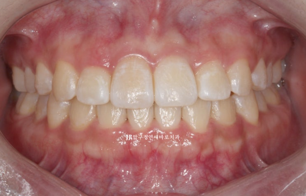 서울 인비절라인 치과 재교정 뻐드렁니 교정 관련 이미지 6