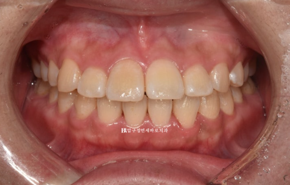 서울 인비절라인 치과 재교정 뻐드렁니 교정 관련 이미지 1