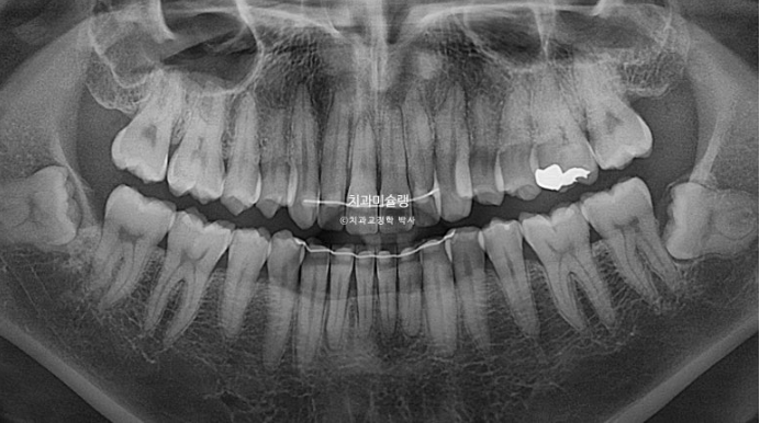 덧니 앞니 부분교정 급속교정 단기 MTA 미니튜브 기간 6개월 관련 이미지 17