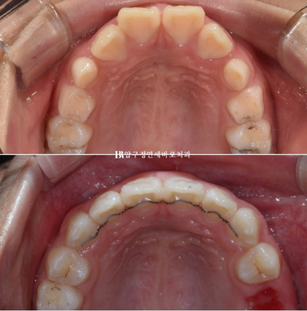 압구정 어린이교정 인비절라인 퍼스트 악궁확장 덧니 교정 관련 이미지 12