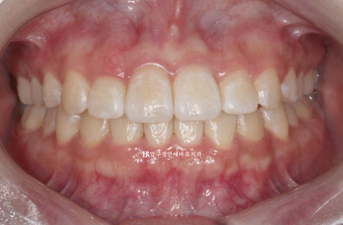 인비절라인라이트 재교정 뻐드렁니 교정 돌출 교정 관련 이미지 6