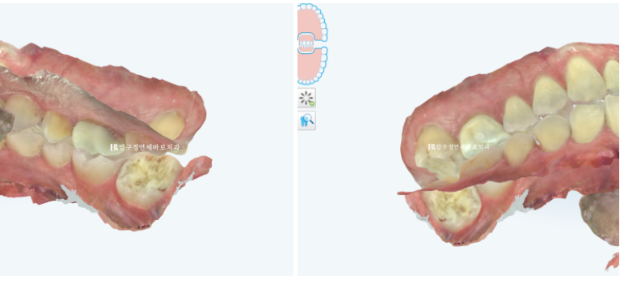 Can Invisalign Lite Work for Patients in Their 40s? A Real Case Improving Scissor Bite and Deep Bite in 10 Months image 7