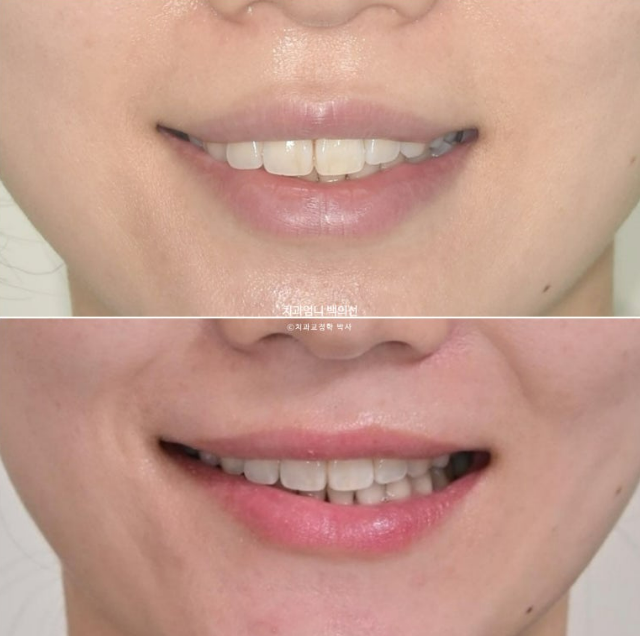 30대 돌출입 발치교정 입술부전증 치료 관련 이미지 1