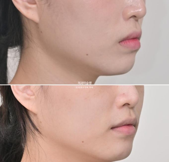 인비절라인 라이트 반대교합? 덧니 중심선 치간삭제 치료 관련 이미지 20