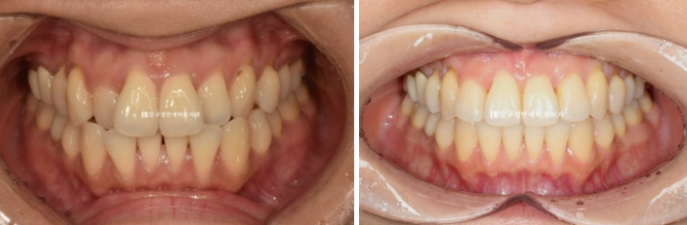 30대 토끼이빨 교정 반대교합 앞니 부분교정 후기 관련 이미지 6