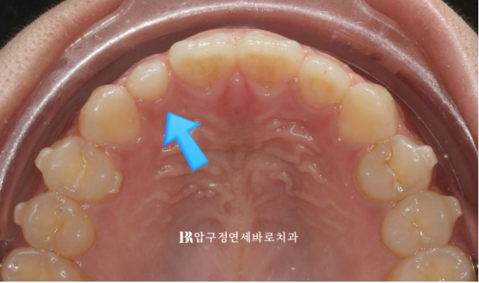 벌어진 앞니, 인비절라인과 무삭제 라미네이트로 자연스럽게 해결 관련 이미지 7