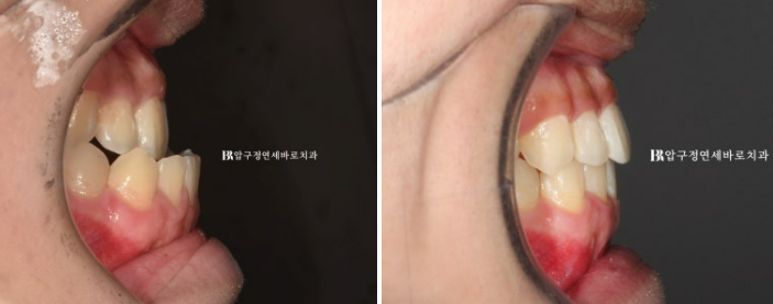 양악수술 교정 인비절라인 주걱턱 교정 치료 후기 관련 이미지 11
