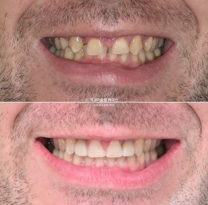 앞니 선천적 결손 인비절라인 임플란트 과개교합 치료 기간 관련 이미지 29