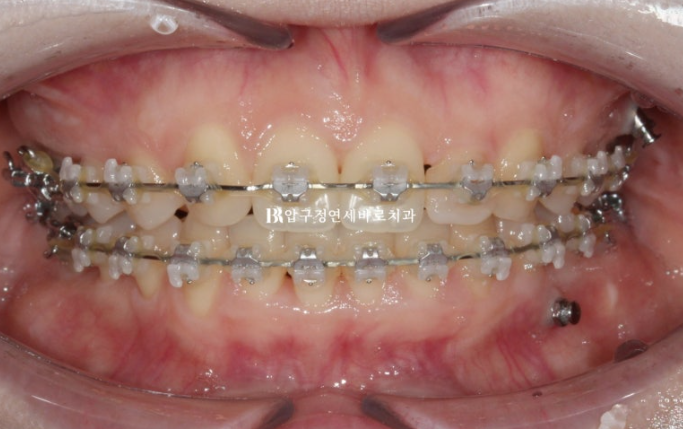 Actual Case of Treating Congenitally Missing and Peg-Shaped Teeth Without Implants image 9