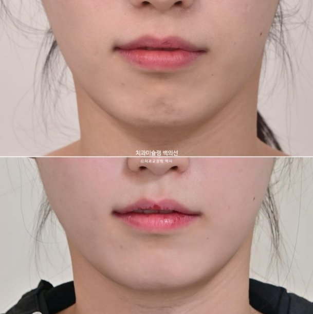 잇몸미소 인비절라인 거미스마일 토끼이빨 교정 무삭제 라미네이트 반대교합 치료 후기 관련 이미지 13