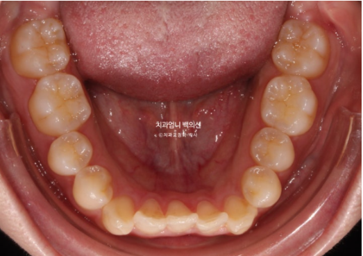 Inward-Tilted Teeth Orthodontic Treatment Review | A Real Case of Treating Congenitally Missing Lower Incisor (Three Lower Front Teeth) Without Extractions image 5