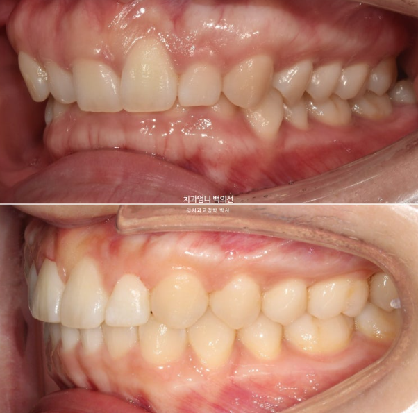 거미스마일 과개교합 교정 잇몸돌출 잇몸 비대칭 관련 이미지 16