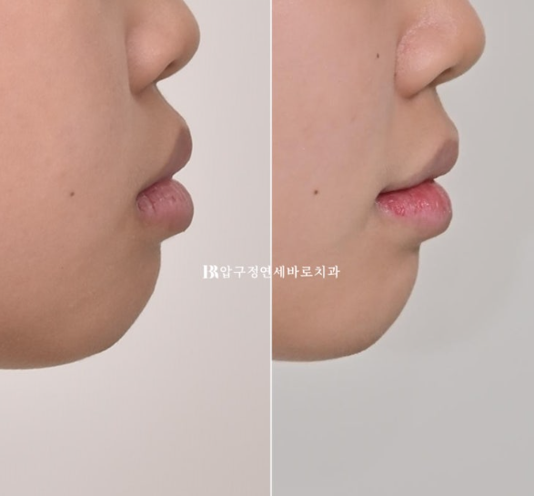 A Child’s Protruding Teeth Correction Review: Difficulty Closing the Lips image 18