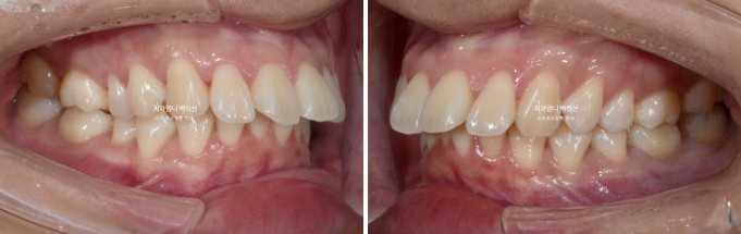 돌출입 교정 인비절라인 발치 교정 후기 관련 이미지 3