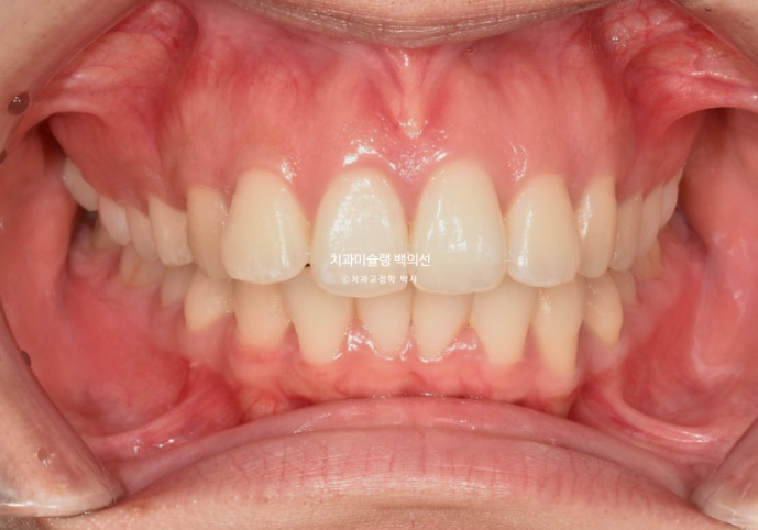 비발치 인비절라인 교정 돌출입 교정 후기 관련 이미지 2