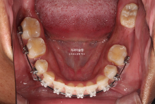 Extraction & re-orthodontics with Clippy-C, intrusion for dental implant. 관련 이미지 11