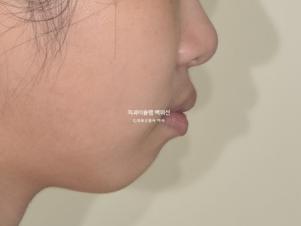 돌출입 무턱 인비절라인 발치교정 덧니 치료기간 1년 11개월 관련 이미지 6