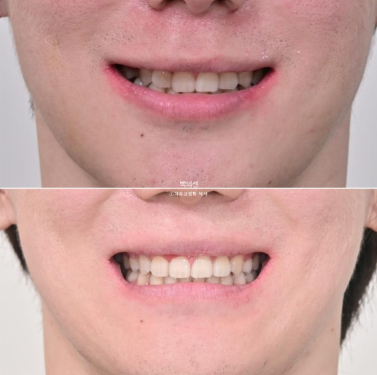 돌출입 수술 ASO + 인비절라인 라이트 후교정 치료기간 10개월 관련 이미지 18