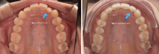 앞니 부분교정은 어떤 경우에 가능한가요? 단기 앞니 부분교정 왜소치 치료 무삭제 라미네이트 관련 이미지 10