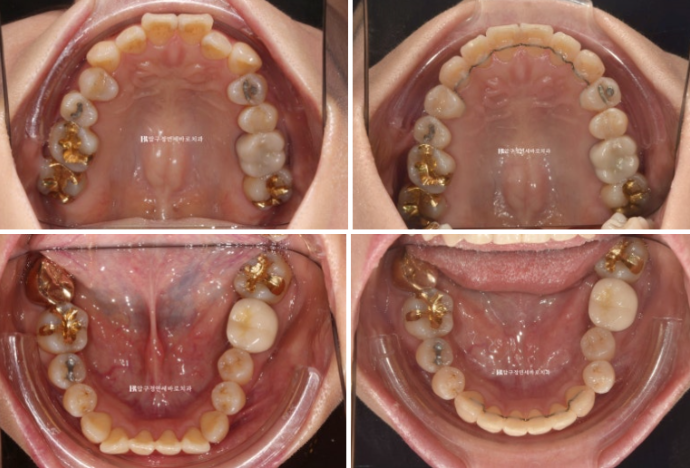 Orthodontics in Your 40s: Worried Your Gums Will Recede? | A 6-Month Front Teeth Partial Orthodontic Case That Also Improved Black Triangles image 9
