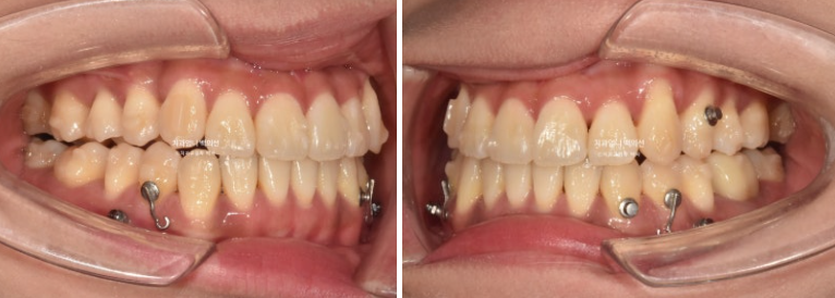 비발치 교정 덧니 인비절라인 교정 절단교합 반대교합 치료기간 1년 6개월 관련 이미지 13