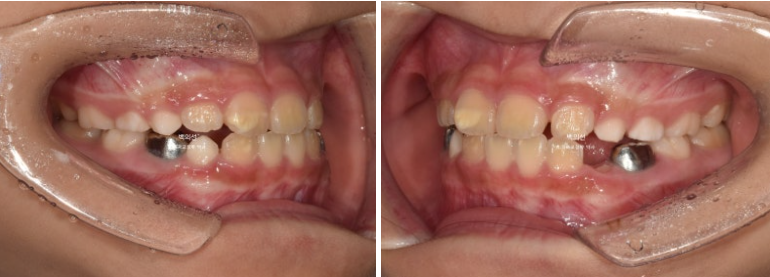 소아 비대칭 교정 인비절라인 퍼스트 재제작 1회 MA 치료 관련 이미지 5