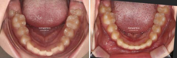 과개교합 인비절라인 모더레이트 컴프레헨시브 중심선 토끼이빨 관련 이미지 14