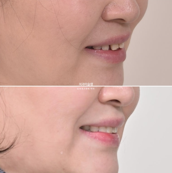 50대 치아교정 돌출 치아벌어짐 중년교정 관련 이미지 21