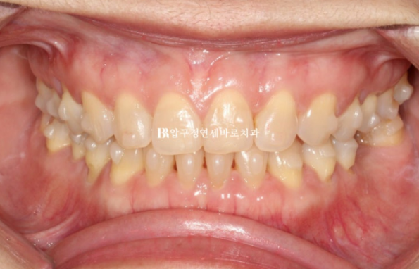 Can Gaps Between the Front Teeth Be Treated with No-Prep Veneers Alone? A Real Case Completed with Gelami After Invisalign Lite image 11