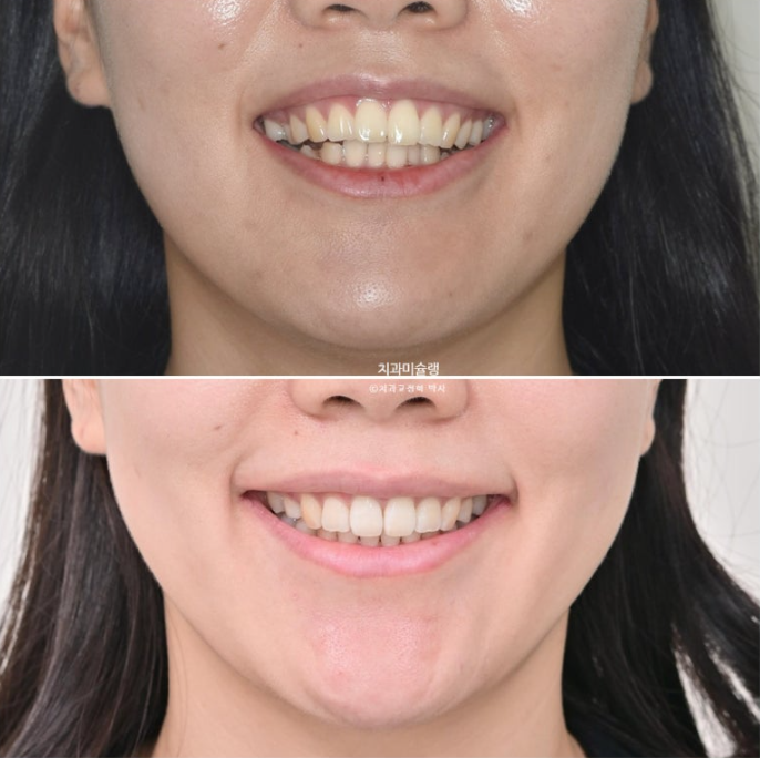 돌출입 덧니 발치 교정 인비절라인 교정 후기 관련 이미지 26