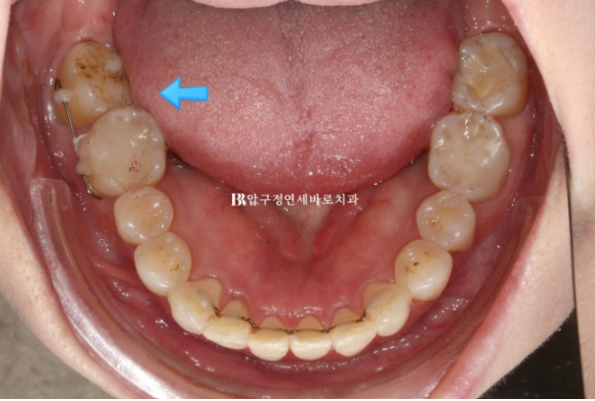 Can Invisalign Lite Work for Patients in Their 40s? A Real Case Improving Scissor Bite and Deep Bite in 10 Months image 12