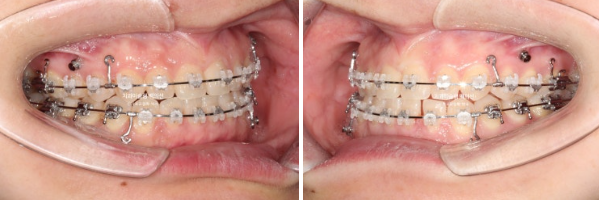앞니 벌어짐 합죽이 방지 교정 기간 1년 4개월 관련 이미지 6