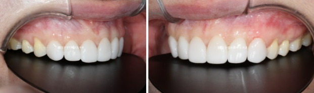 Can Gaps Between the Front Teeth Be Treated with No-Prep Veneers Alone? A Real Case Completed with Gelami After Invisalign Lite image 19